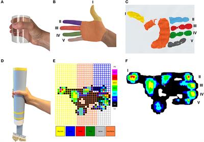 Dynamic Manugraphy as a Promising Tool to Assess the Outcome of Limited Aponeurectomy in Patients With Dupuytren's Contracture